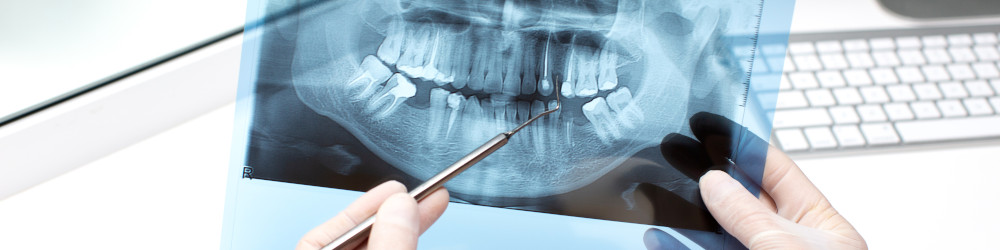 radio implants dentaire amiens